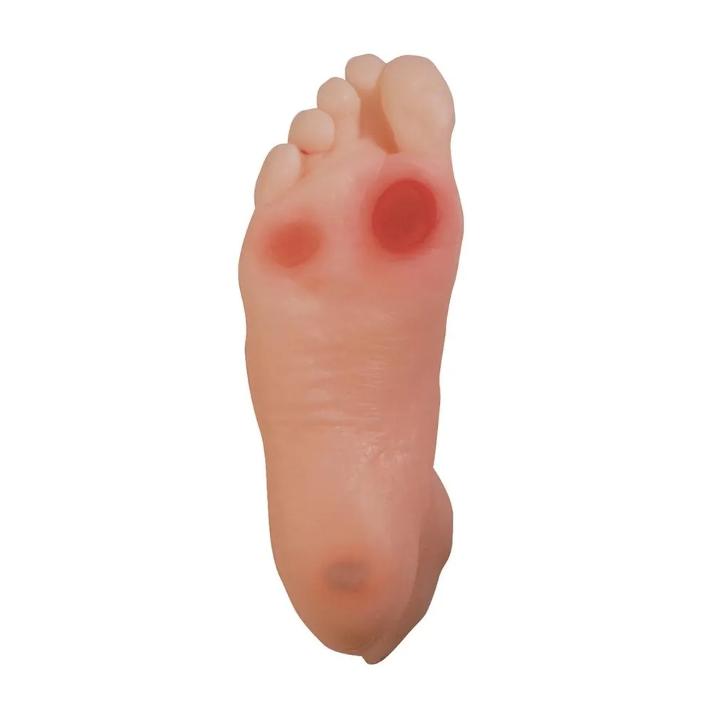 Diabetic Foot Model